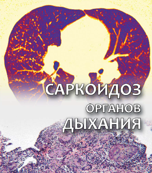 Реферат: Саркоидоз